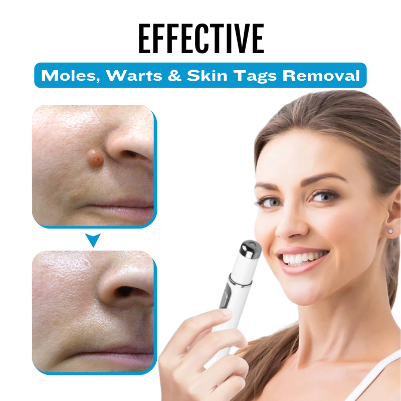 🔥【OFFICIAL STORE】Non-Invasive Mole and Wart Laser Pen