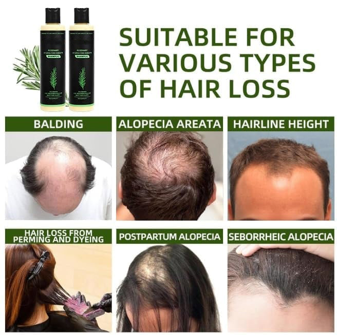 👑2026✨LAST DAY SALE 70% OFF!🏆Organic Rosemary Hair Growth Shampoo