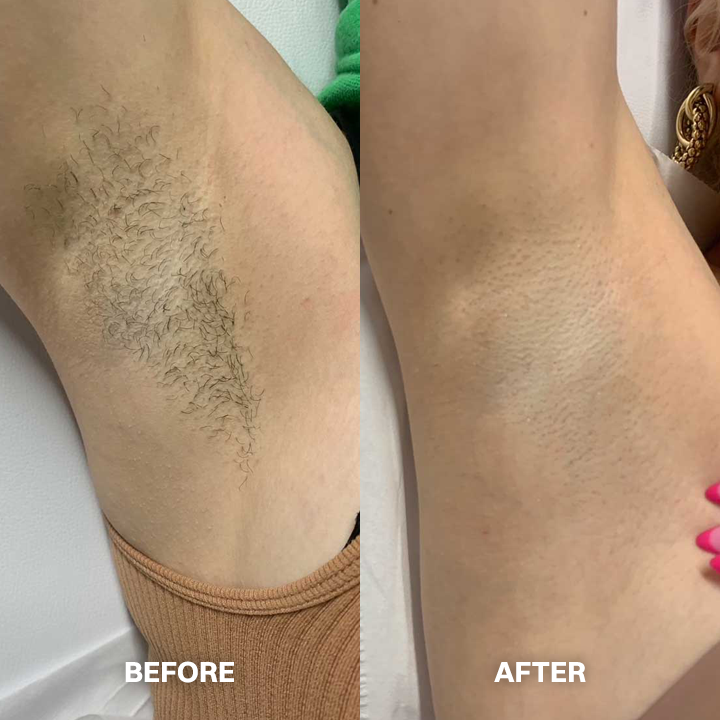 Hair Removal Cream for All Women & Men