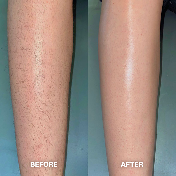 Hair Removal Cream for All Women & Men