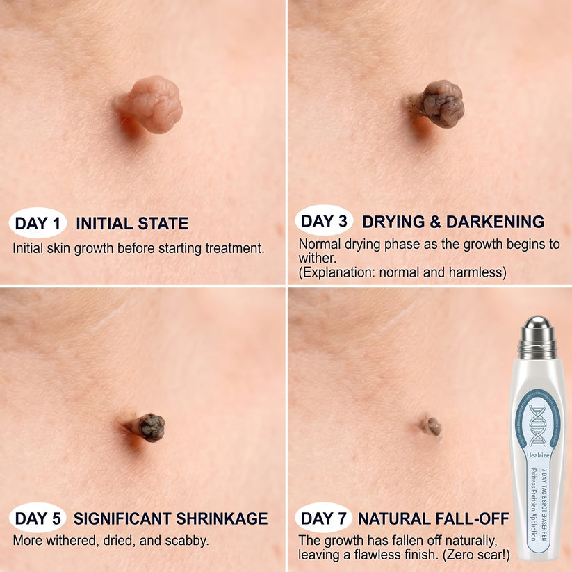 🖊 Advanced Wart & Skin Tag Removal Pen