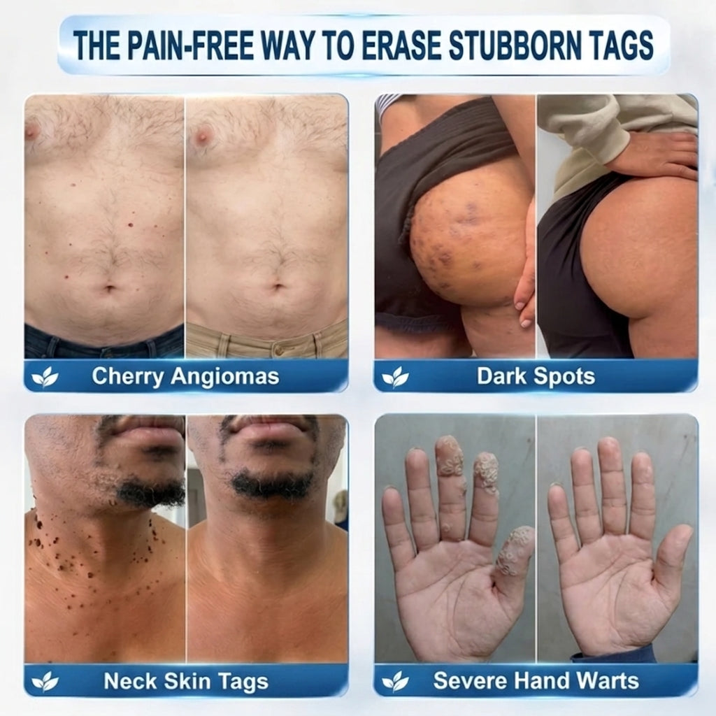 🖊 Advanced Wart & Skin Tag Removal Pen