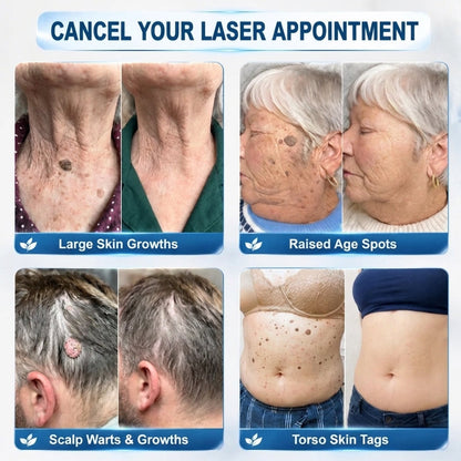 🖊 Advanced Wart & Skin Tag Removal Pen